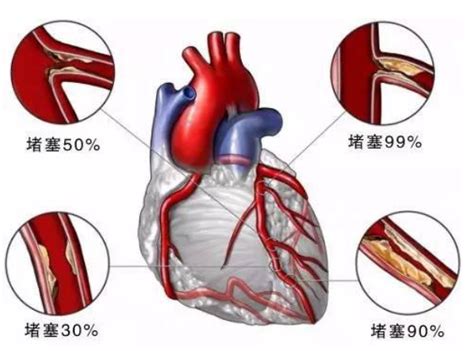 心脏缺口是大病吗