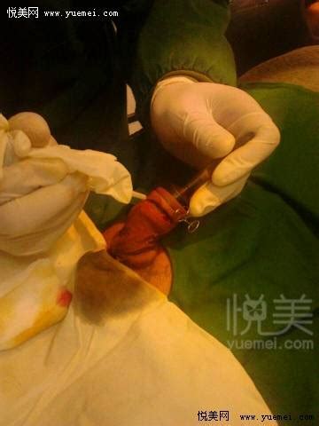 男孩变女孩手术后的变化