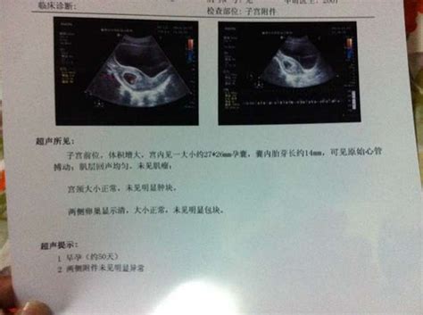 孕7周有胎心胎芽hcg8千左右