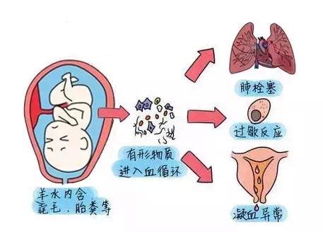 胎盘早期剥离的诱因及其影响