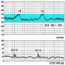 胎心监护的曲线怎么看才算正常