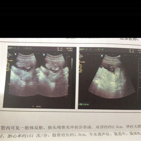 怀孕七个月的胎儿图片真实