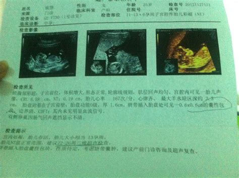 孕期超声检查对宝宝有影响吗