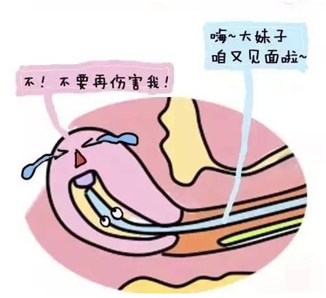 什么是钳刮人工流产