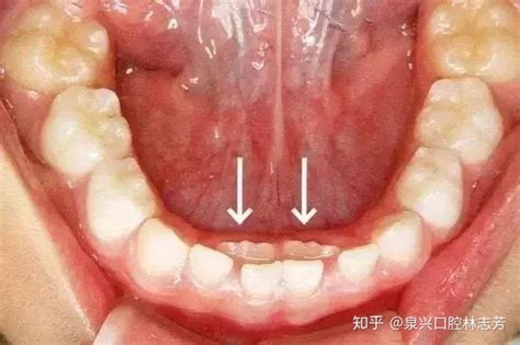 假牙装上后嘴瘪怎么办