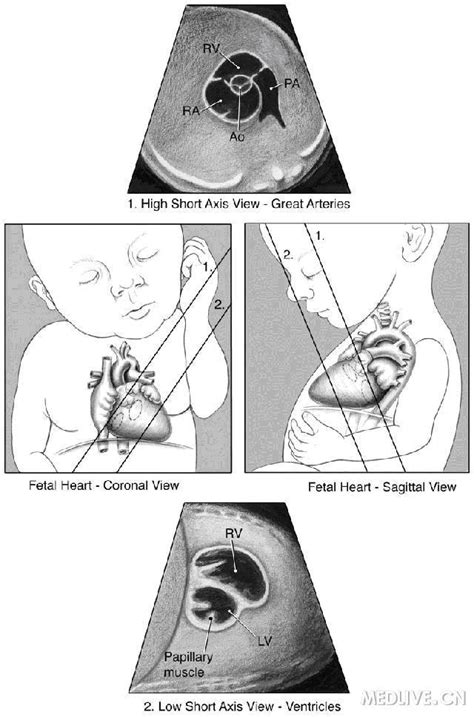 32周胎儿心脏有强回声点