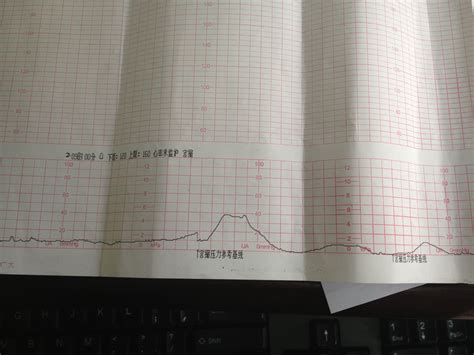 胎心监护中的图片