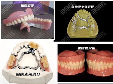 活动义齿单颗多少钱