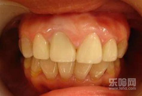 孩子牙齿发黄是什么原因