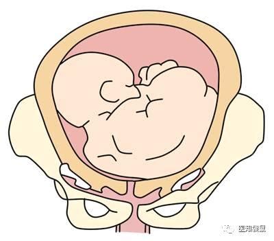 孕38周胎位不正能转吗