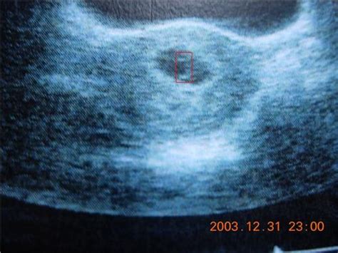 胎芽1.1厘米不见胎心