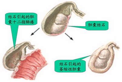 有胆结石和肾结石可以吃钙片吗