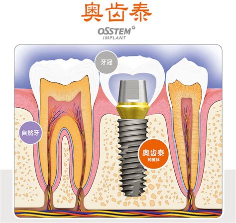 广州种牙口碑最好的牙科