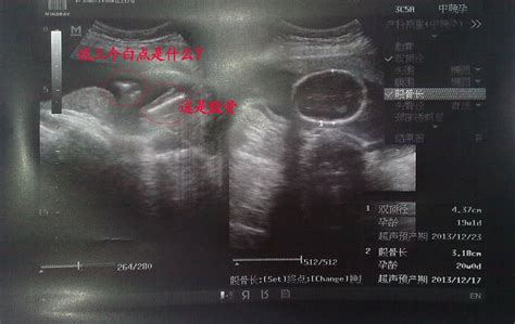 怀孕4个月胎儿大小标准