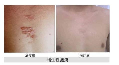 手術后傷口發紅疤痕突出變寬是怎么回事