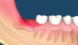 经常牙痛是什么原因引起的牙周炎