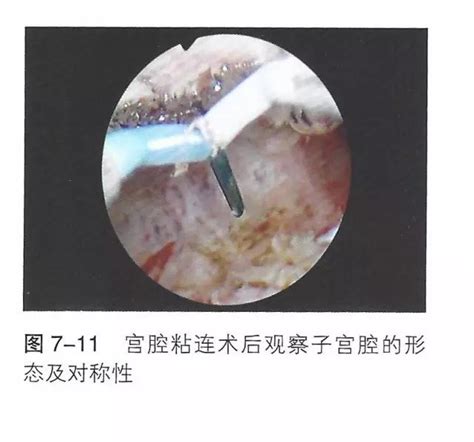 宫腔可见散在光点7x4mm暗区