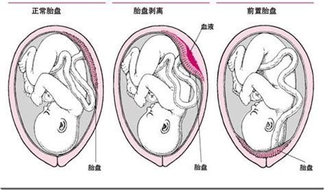 脐带帆状附着可以顺产吗