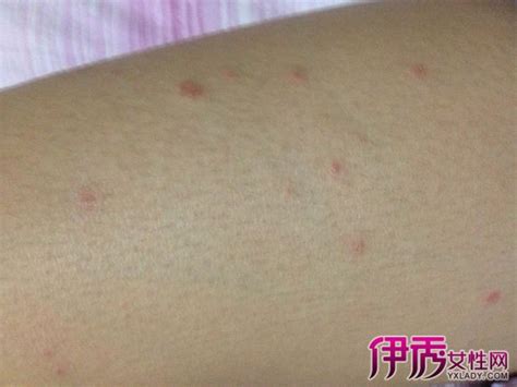 身上红色的小血点变黑了咋回事