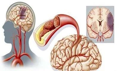 血管堵塞最怕六种食物