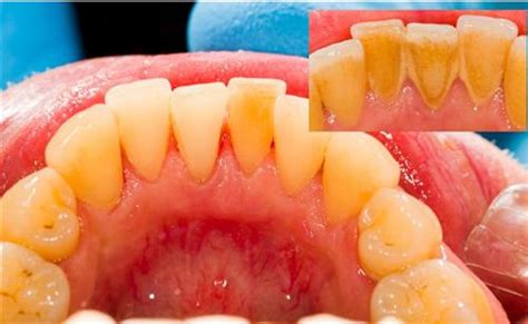 牙科医生实拍医院最强牙石患者,为什么会结牙石