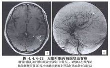 海綿狀血管瘤嚴重嗎