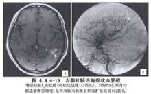 海绵状血管瘤严重吗