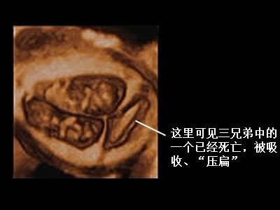 hc是指胎儿的什么意思，hc是指胎儿的什么意思啊？