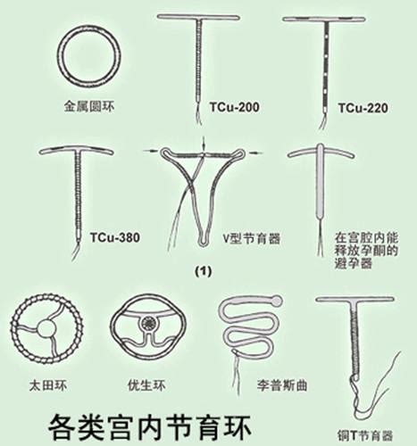 新型避孕環避孕治療有雙效新型女性避孕環