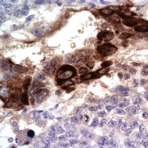 恶性卵黄囊瘤是癌症吗