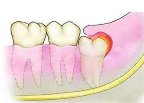 如何缓解拔智齿牙后疼痛
