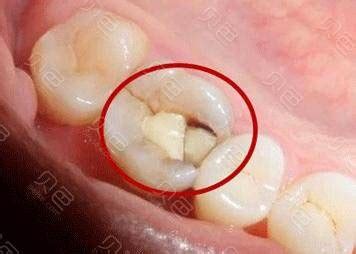 牙槽突裂手术能享受新农合报销吗