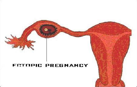 宫外孕最佳挽救方法