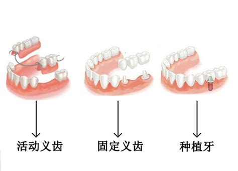 吸附性假牙寿命是多久