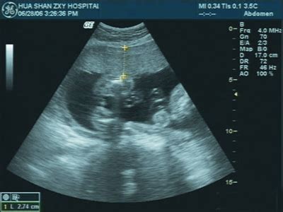 孕期B超检查怎样进行