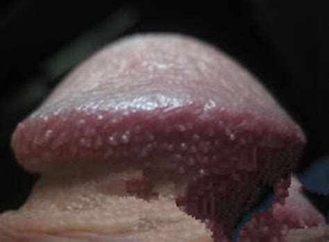 男性假性尖锐湿疣早期症状