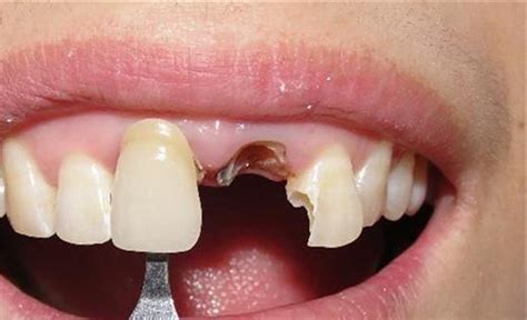 牙龈破损可以粘假牙吗