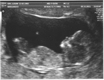 怀孕一个月的b超报告图片