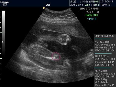 怀孕8周卵黄囊的大小