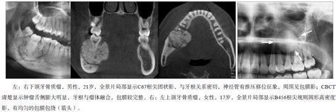 牙槽骨手术价格表