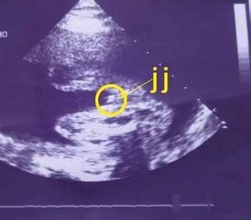 10周胎儿b超图怎么看