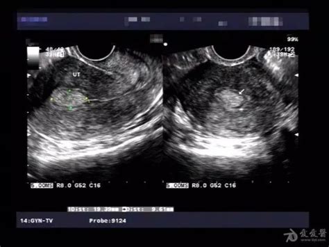 怀孕后发现子宫内膜息肉怎么办