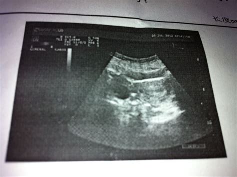 怀孕八周b超显示图片