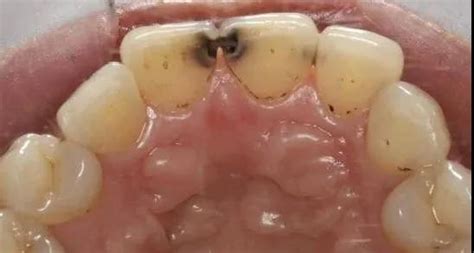 镶的假牙和牙龈之间有缝隙