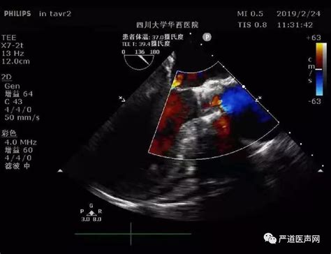 心脏彩超图片