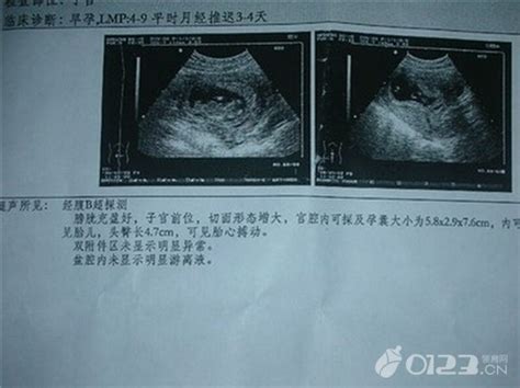 怀孕29周宝宝缺氧