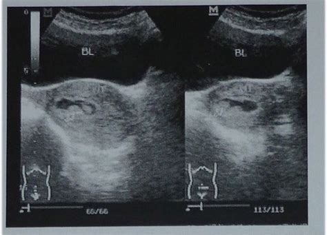 孕早期的b超形状