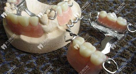 戴活动假牙邻牙有损坏吗