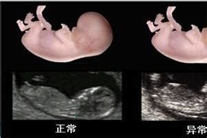 胎儿发育迟缓的原因有哪些