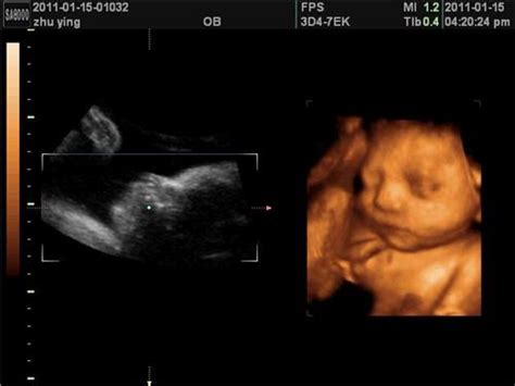16周彩超胎儿图